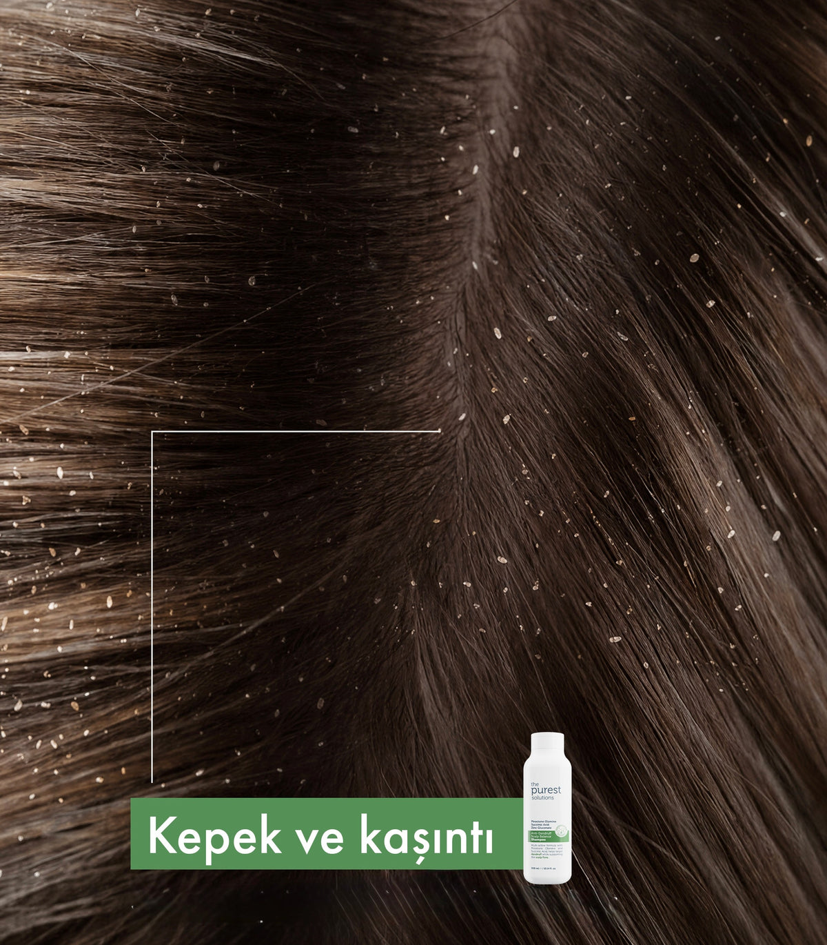 Kepek ve Kaşıntılı Saç Derisi Nasıl Geçer?